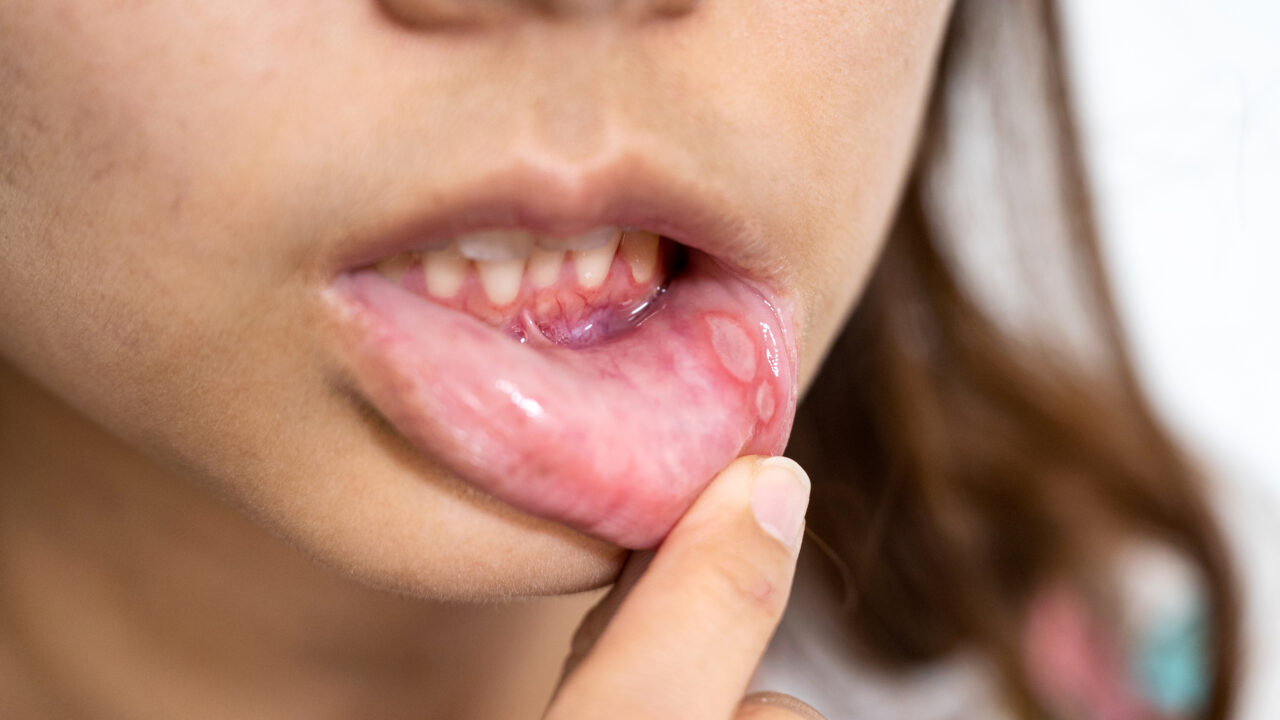 Mouth ulcers