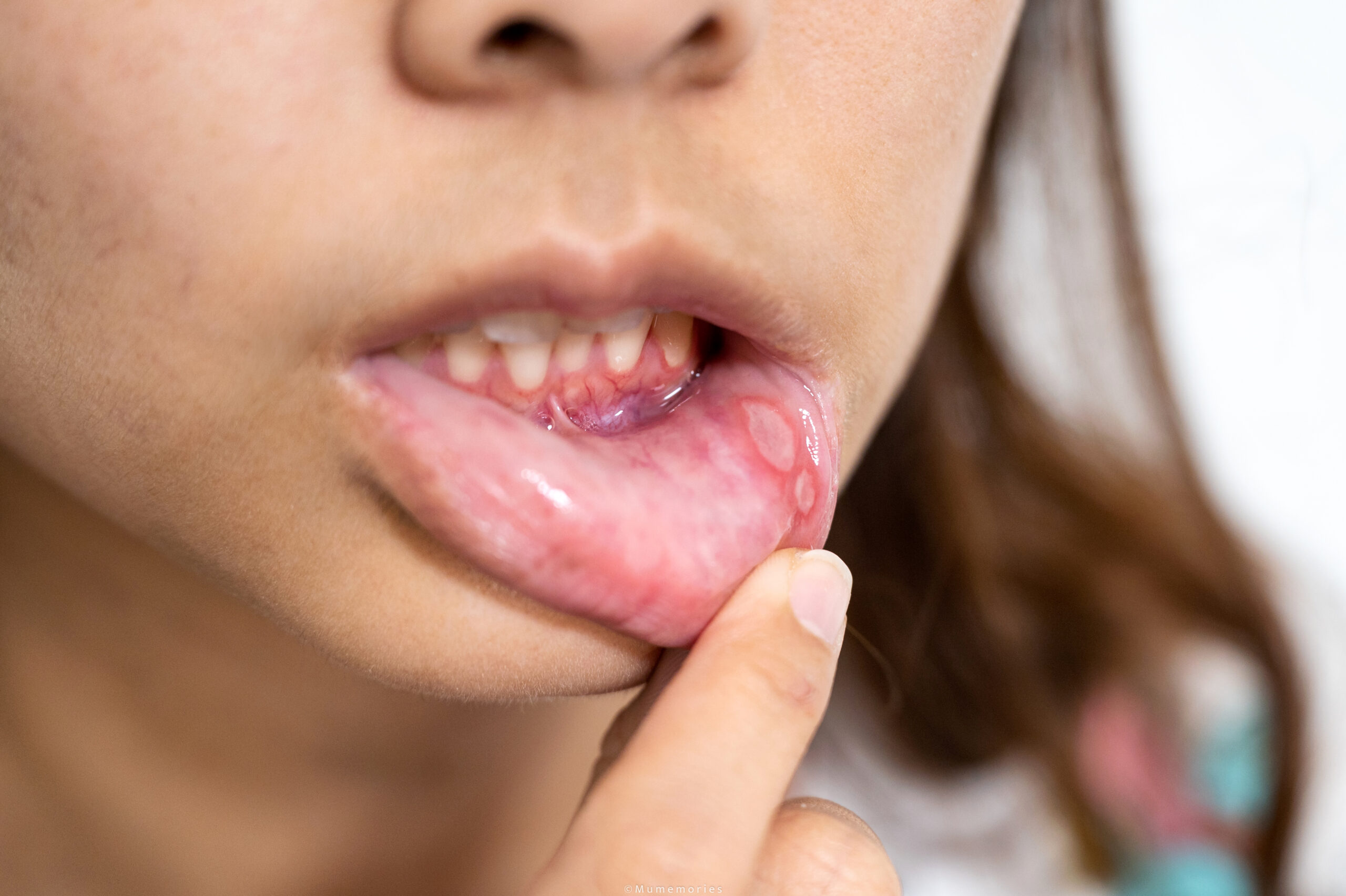 Mouth ulcers