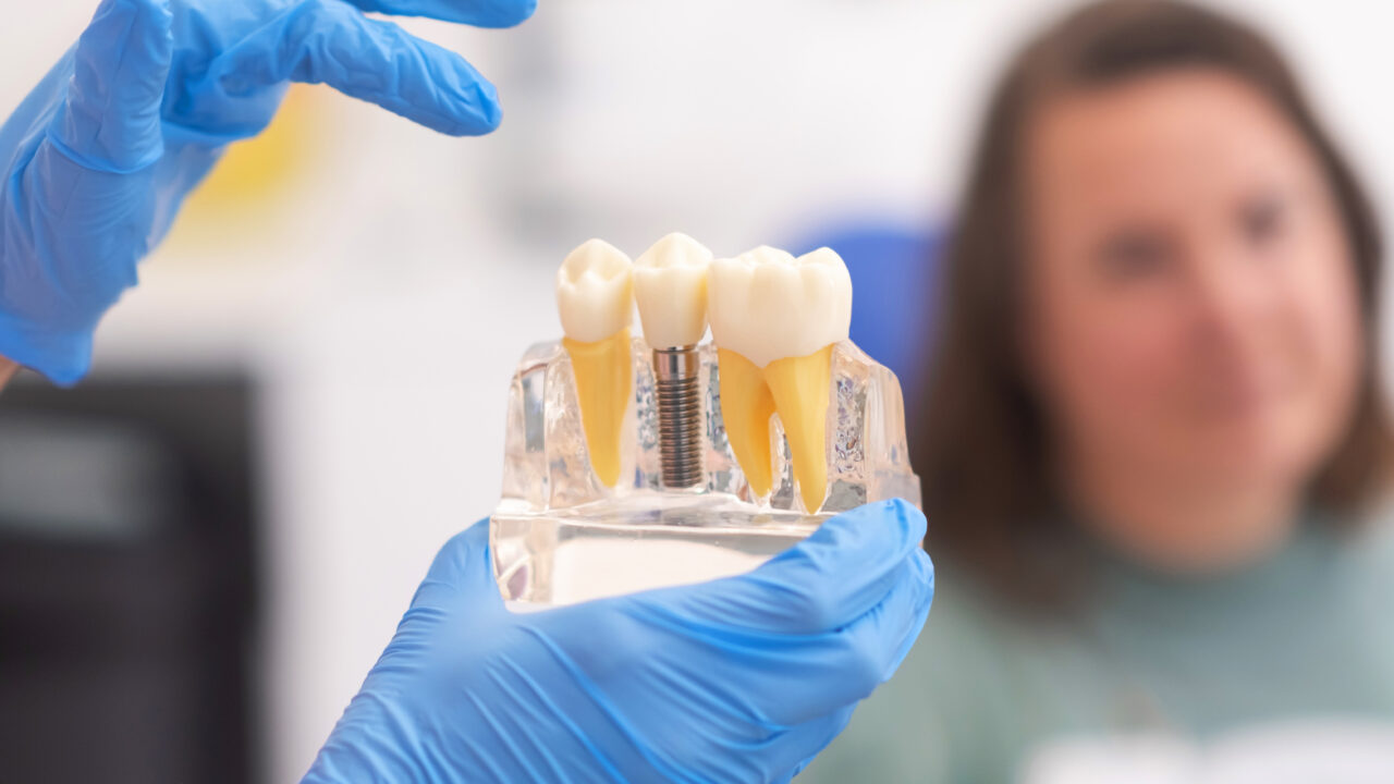 Dental Implants – A viable option for tooth replacement