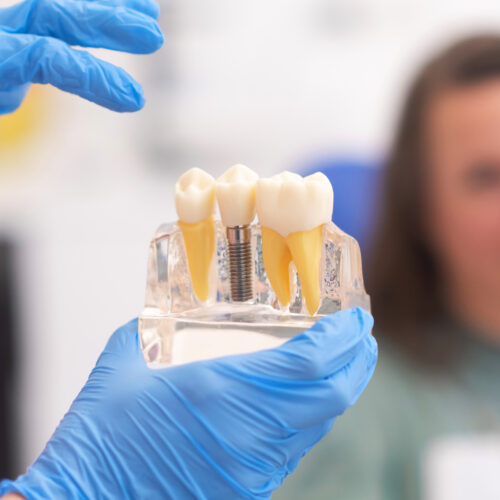 Dental Implants – A viable option for tooth replacement