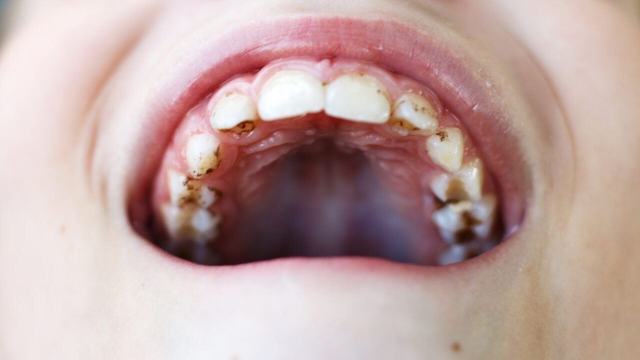 Teeth Decay in unerupted teeth