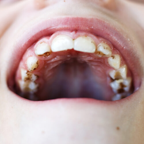 Teeth Decay in unerupted teeth