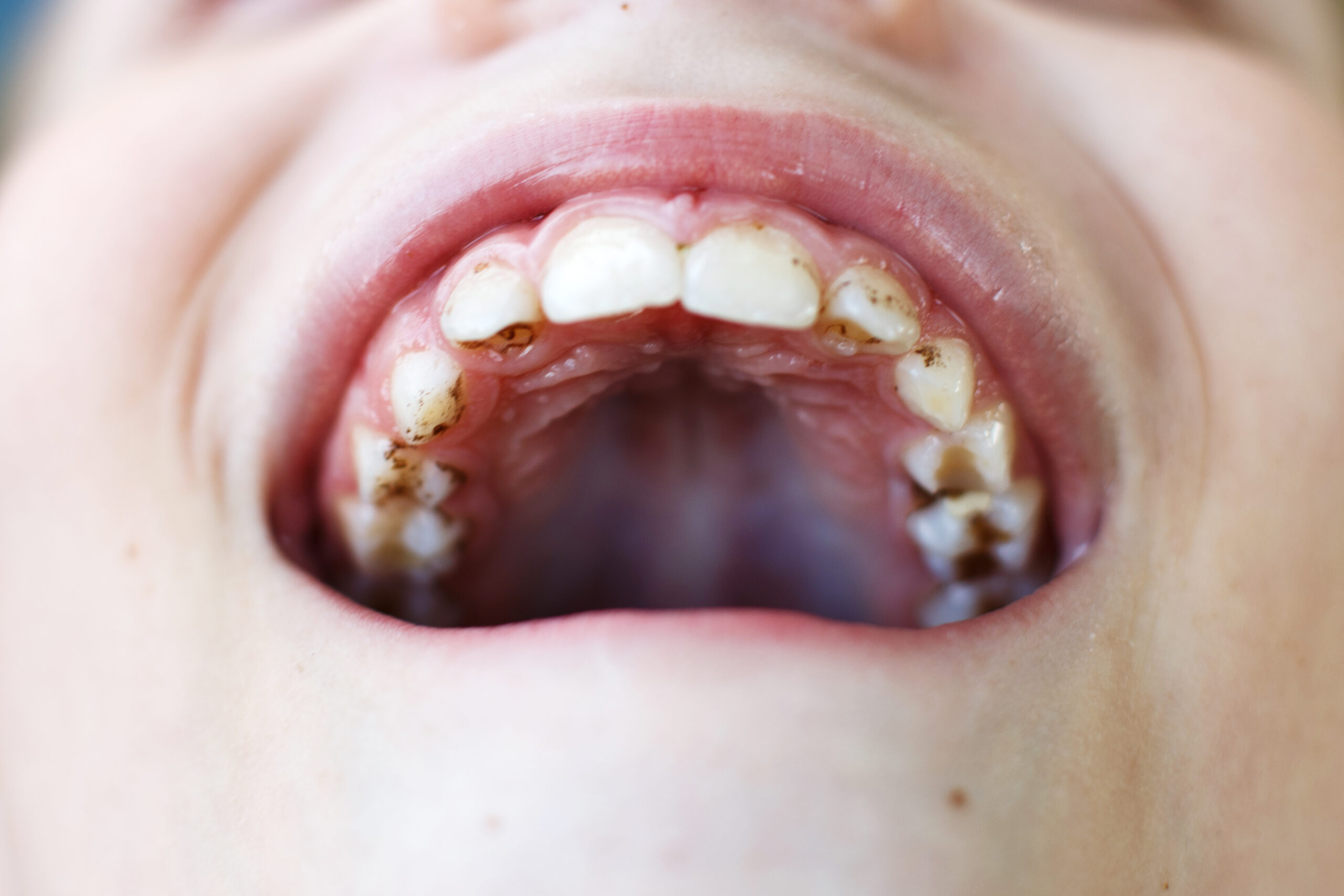 Teeth Decay in unerupted teeth