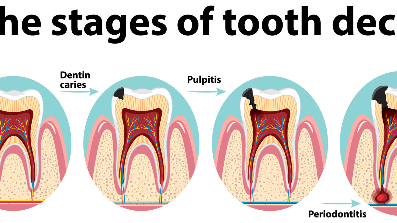 Signs of a to deep cavity to be filled