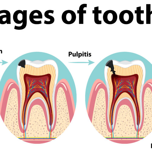 Signs of a to deep cavity to be filled