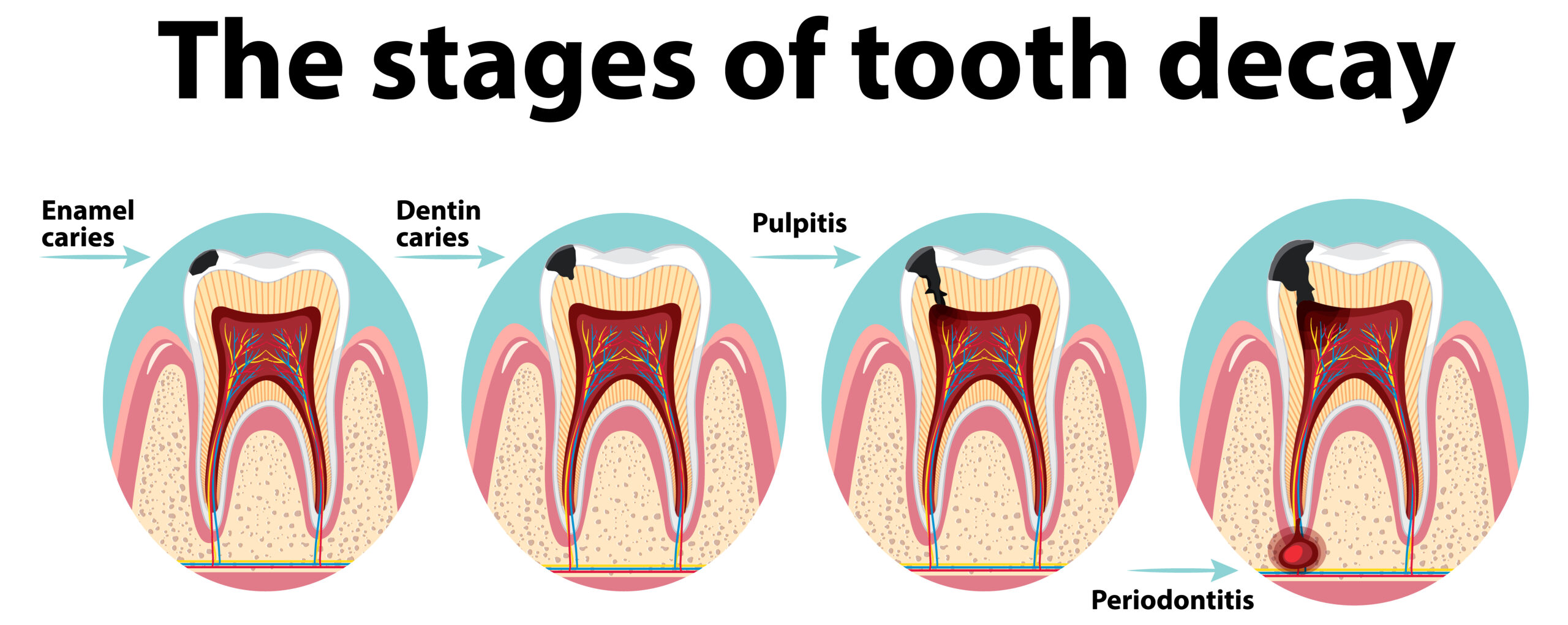 Signs of a to deep cavity to be filled