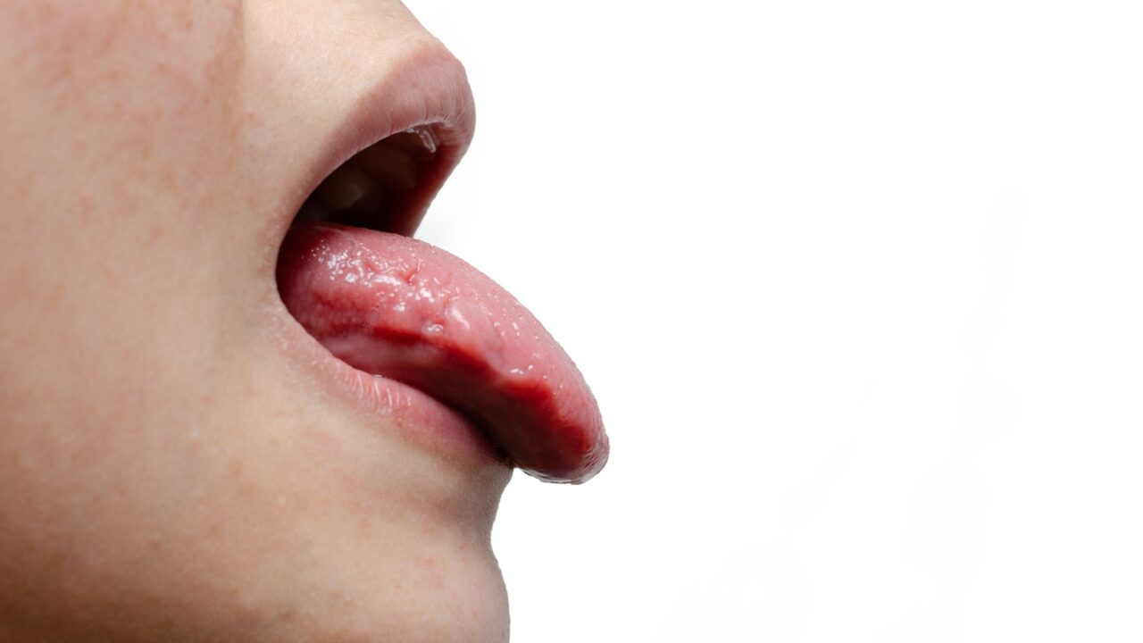 Oral Thrush – Candidiasis