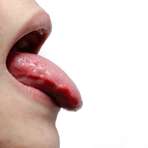 Oral Thrush – Candidiasis