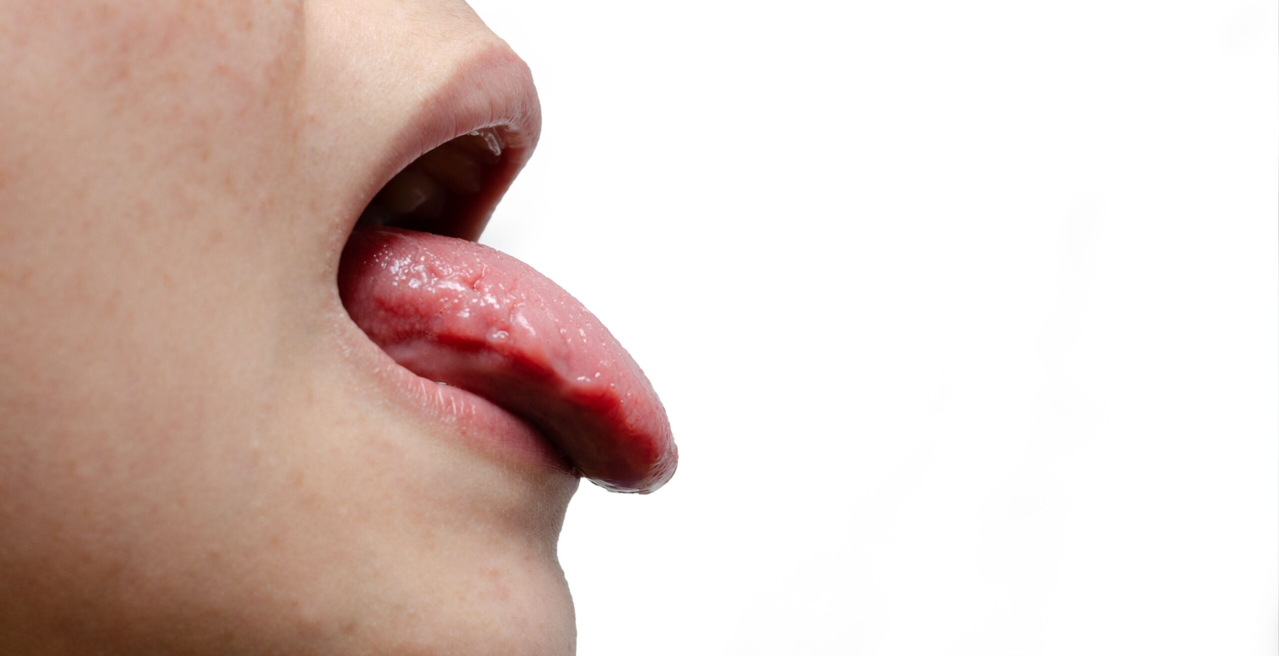 Oral Thrush – Candidiasis