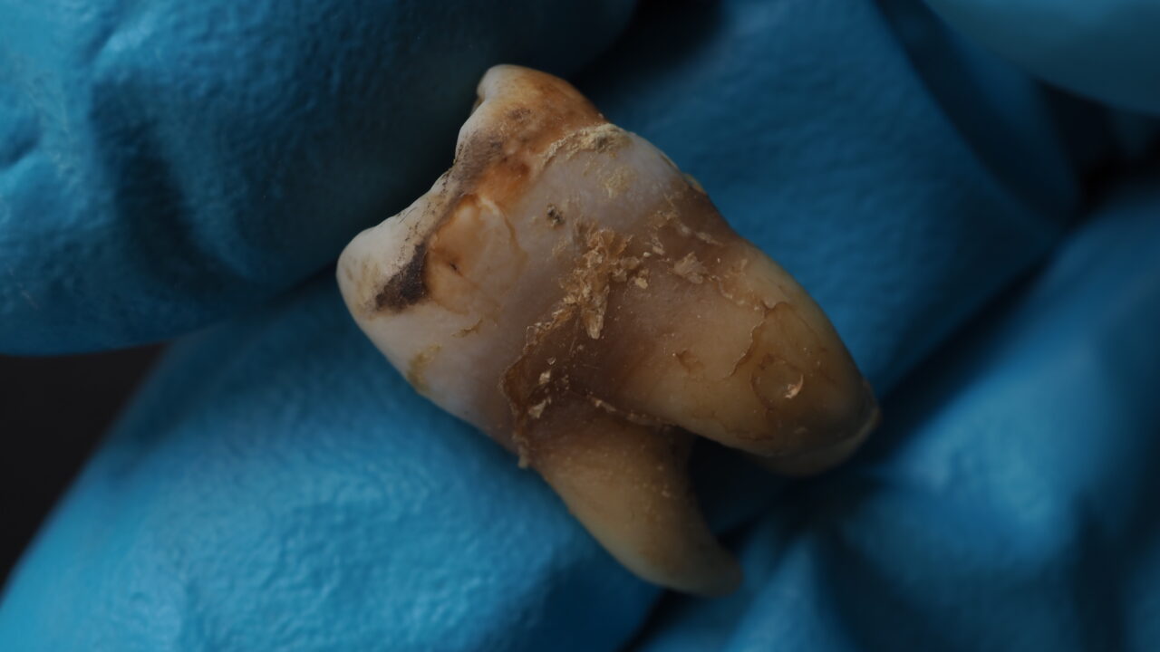 Tartar – calcified dental plaque