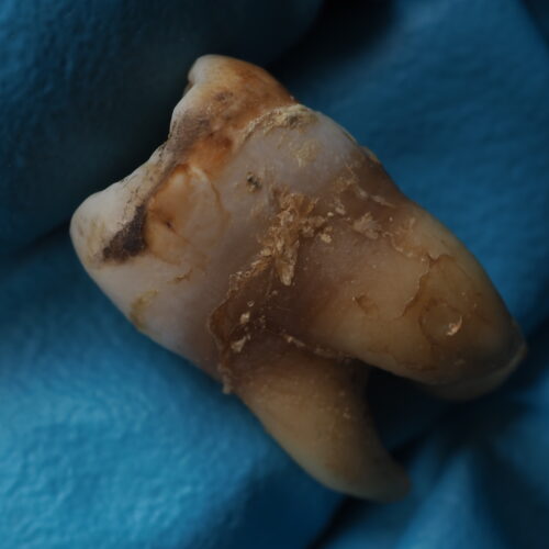 Tartar – calcified dental plaque