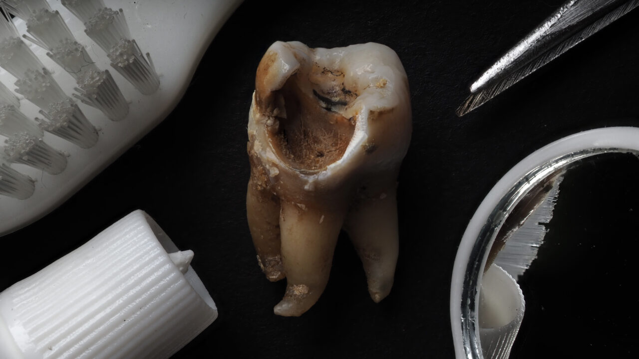 Macro shot of a decayed teeth till root after extraction of dent