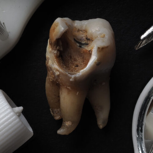 Macro shot of a decayed teeth till root after extraction of dent