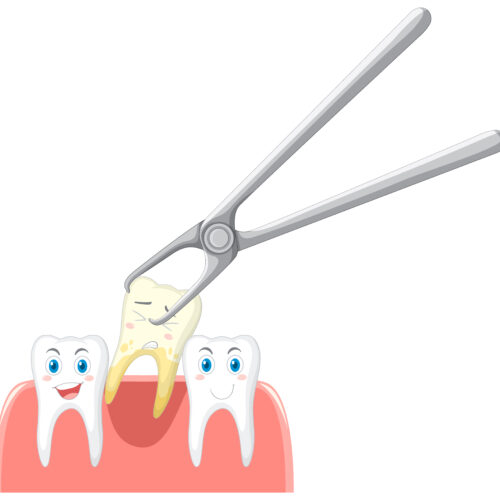 What to do after a tooth extraction?