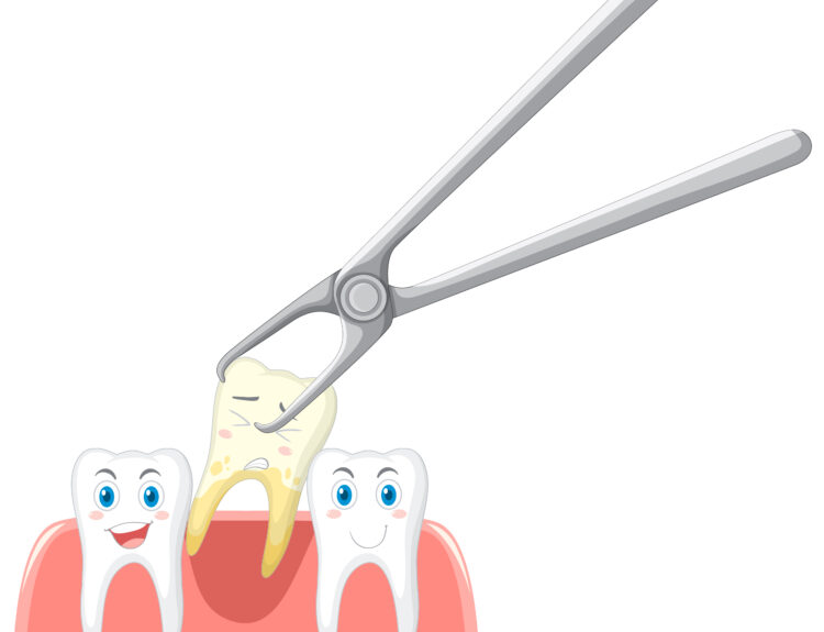 What to do after a tooth extraction?