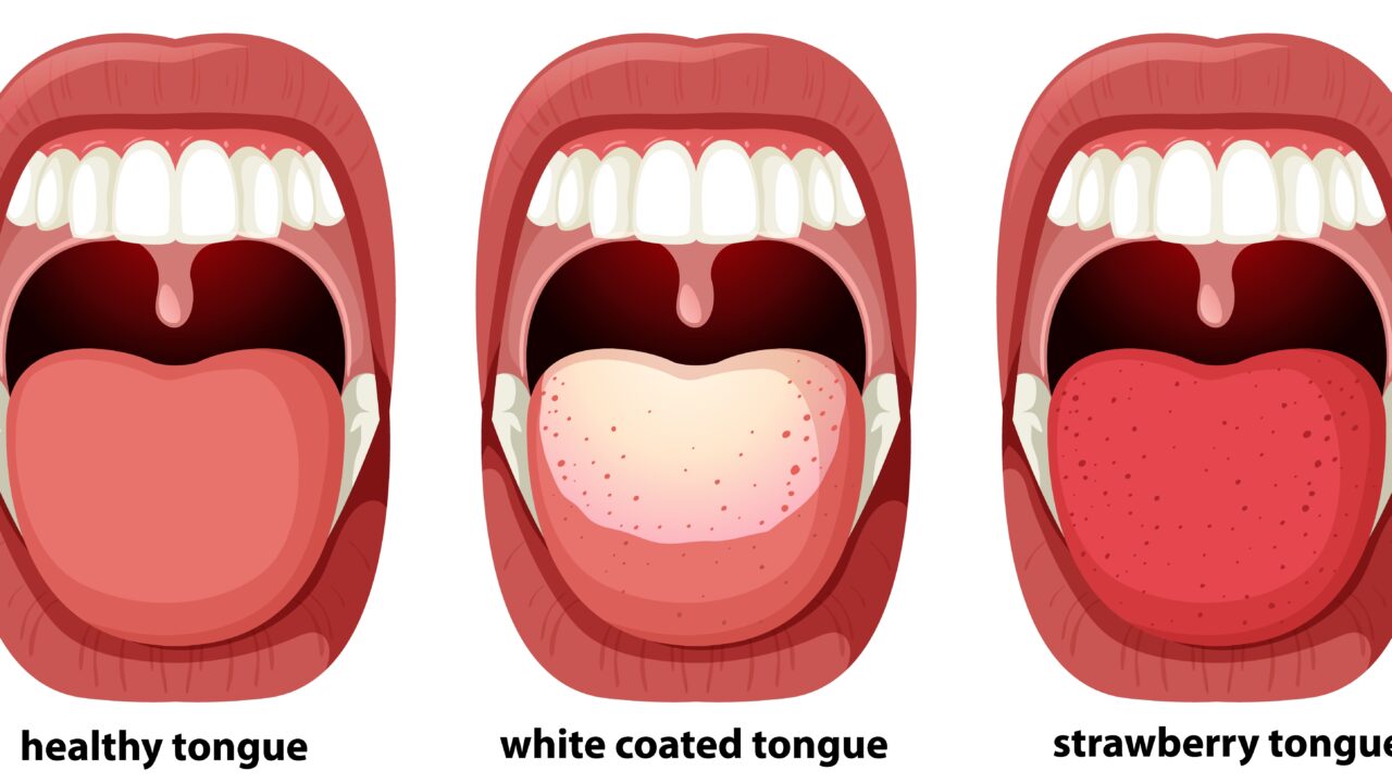 White tongue coating: causes & prevention