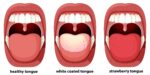 White tongue coating: causes & prevention