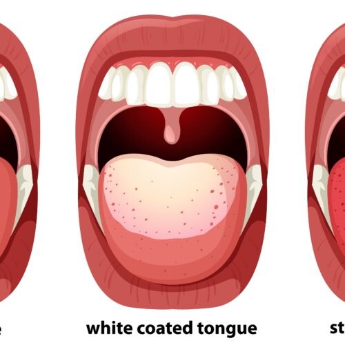 White tongue: causes & prevention