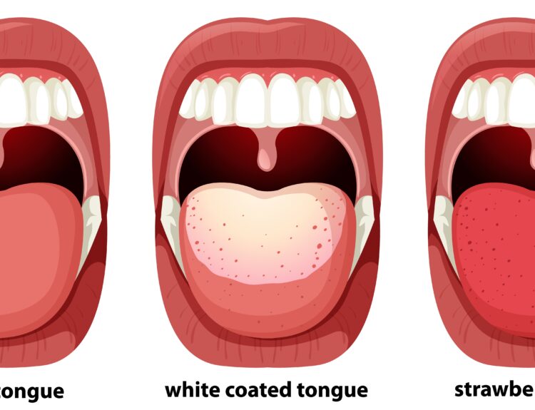 White tongue: causes & prevention