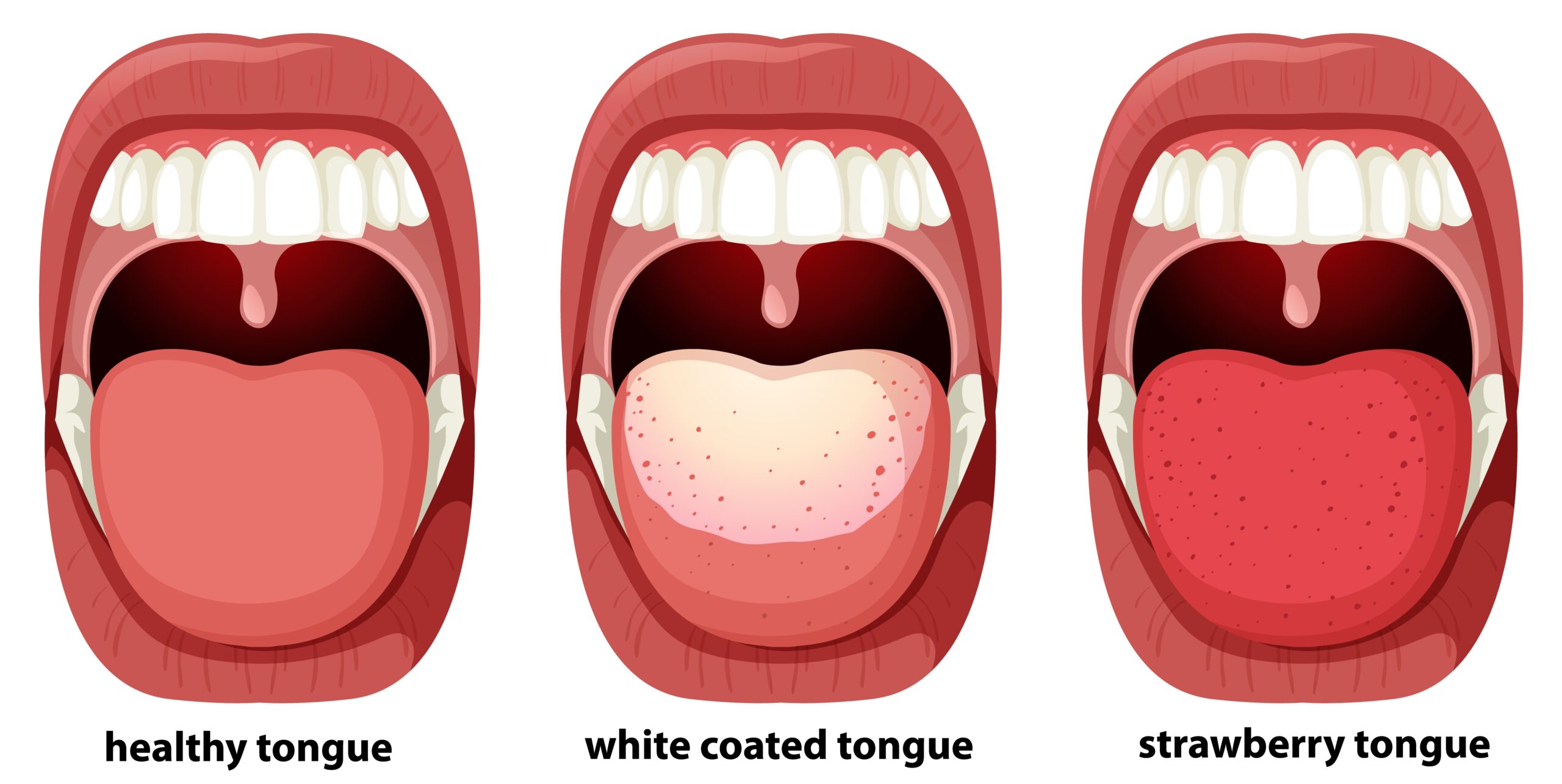 White tongue: causes & prevention