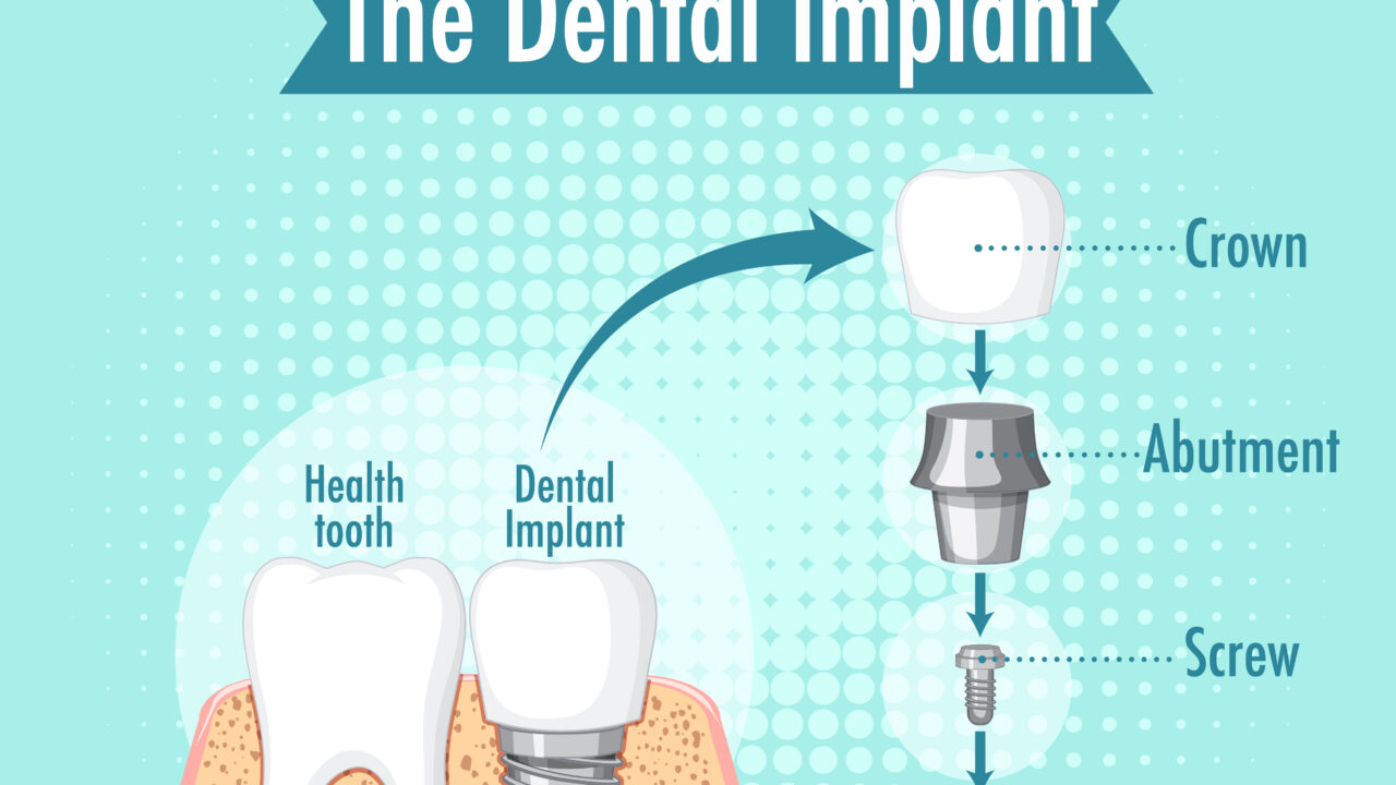 Missing teeth replacement options: An implant or a Bridge