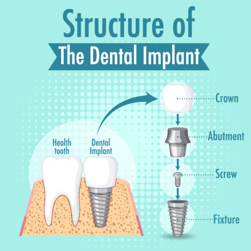 Missing teeth replacement options: An implant or a Bridge