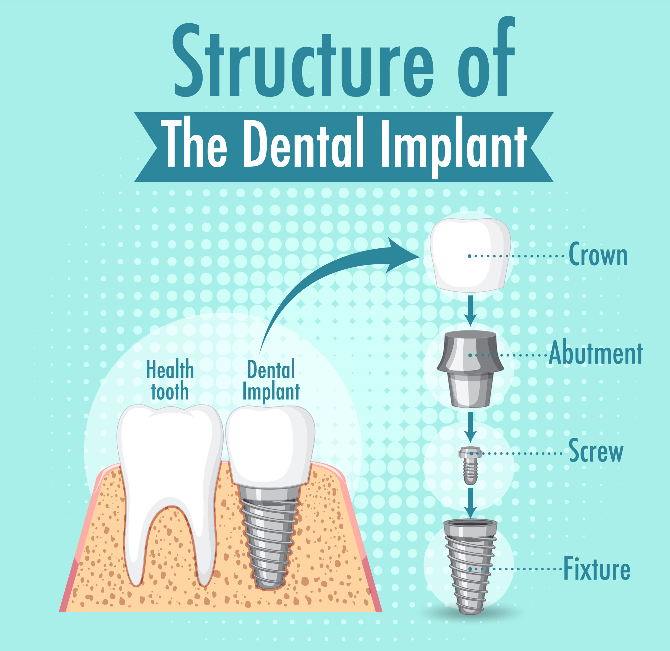 Missing teeth replacement options: An implant or a Bridge