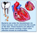 Dental Procedures and Endocarditis: Preventive Measures 