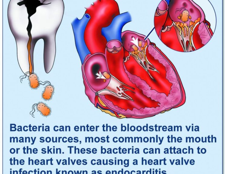 endocarditis