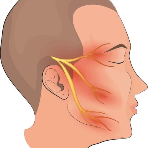 Trigeminal neuralgia