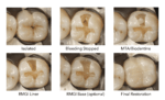 Pulp Capping: Avoiding Root Canal Through Pulp Preservation